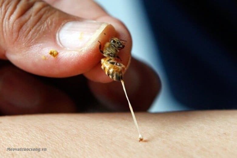 Rút bỏ nọc ong khi bị ong đốt