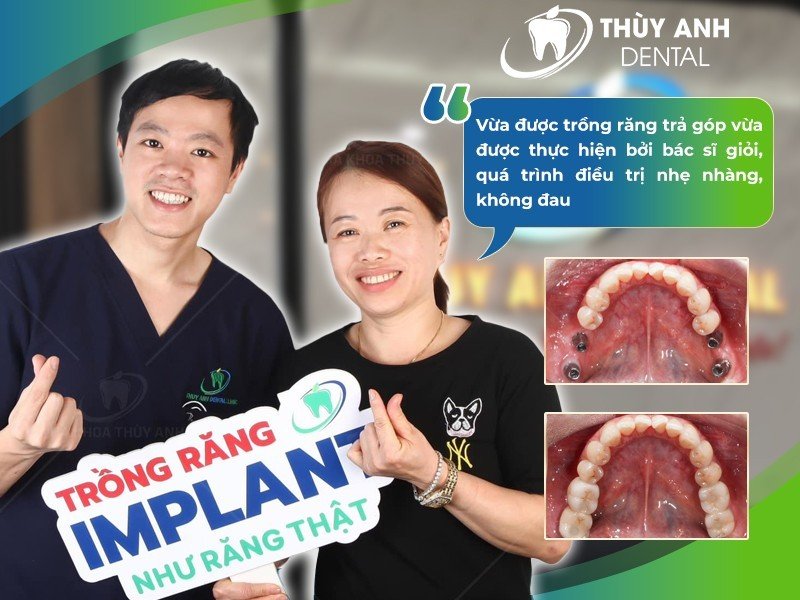 Giá trồng răng implant là bao nhiêu với các trường hợp mất răng khác nhau?